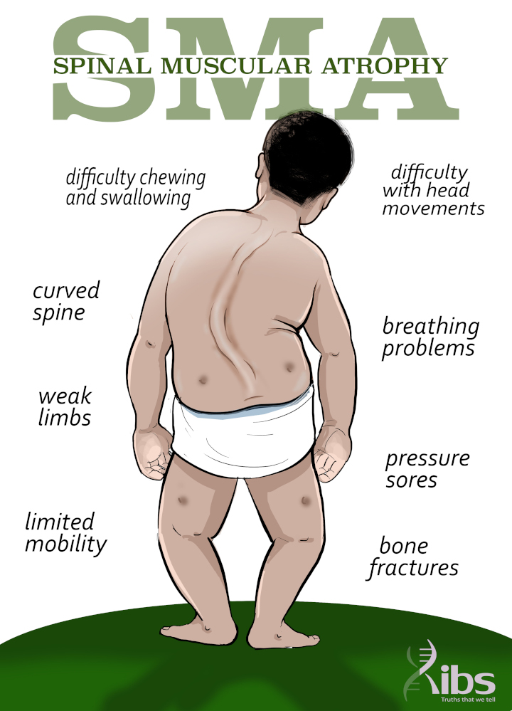 Kenya Spinal Muscular Atrophy test